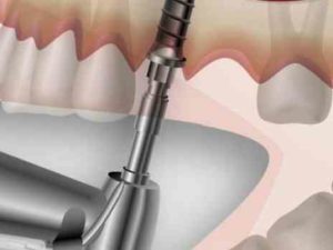 В каком возрасте можно делать синус-лифтинг?