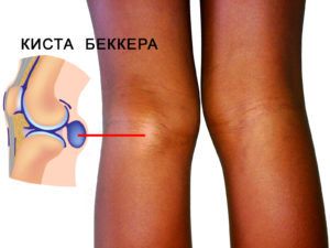 Симптомы кисты Бейкера