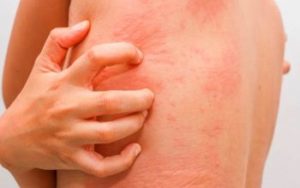 Причины аллергии у взрослых