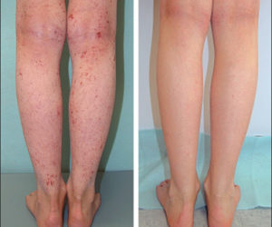 Способы лечения атопического дерматита