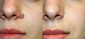 Понятия родинок и папиллом, методы удаления