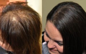 Насколько эффективна озонотерапия для волос?