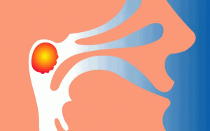 Как удаляют аденоиды?