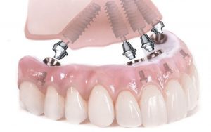 Показания к синус-лифтингу и особенности выполнения операции