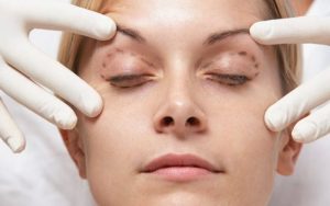 Как осуществляется лазерная блефаропластика?