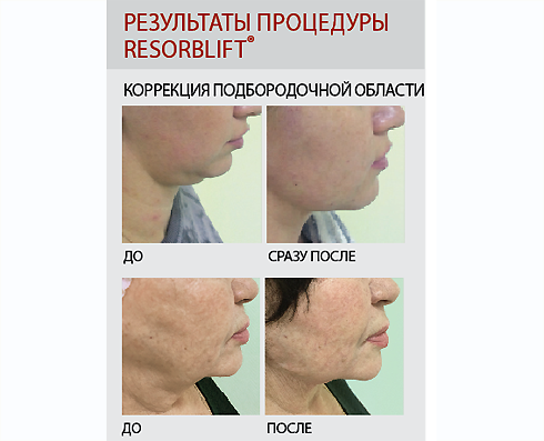 Как убрать двойной подбородок