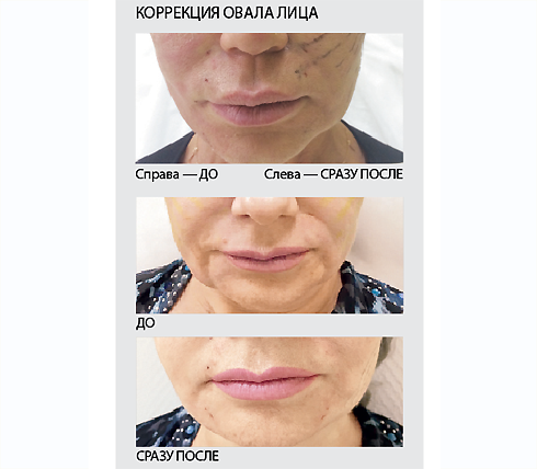 Как убрать двойной подбородок