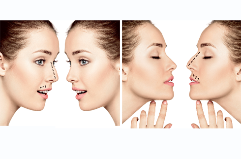 Не вешать нос: все о безоперационной ринопластике