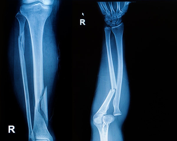 
    Осторожно, гололедица! Как избежать переломов  