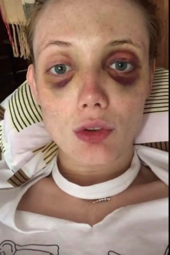 Известную модель Киру Фокс жестоко избил муж