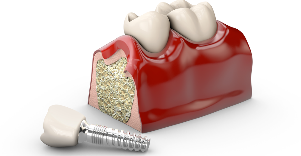 Имплантация зубов: вернуть уверенность улыбки и радость жизни