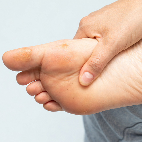 Удаление подошвенных бородавок лазером: эффективное решение для вашей кожи