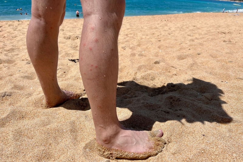 Лихорадка чикунгунья: есть ли опасность в России? 