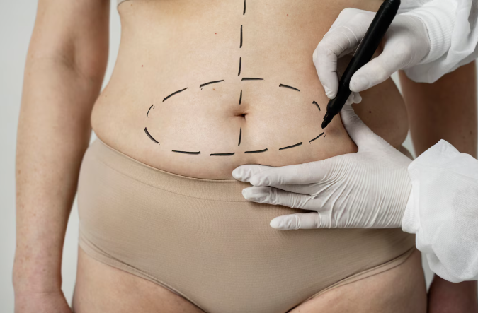 Абдоминопластика: когда стоит рассмотреть операцию и как проходит процесс?