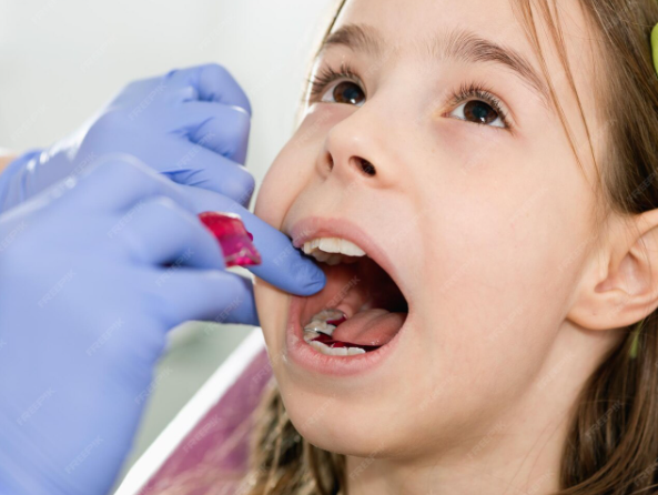 Лечение гингивита у детей: здоровье зубов с самого раннего возраста